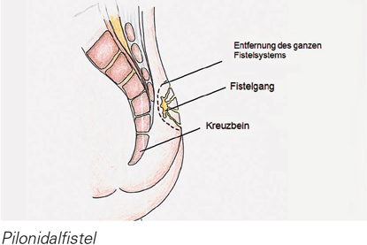Eine Fistel im Bereiche des Steissbeines kann nur durch eine Operation endg...